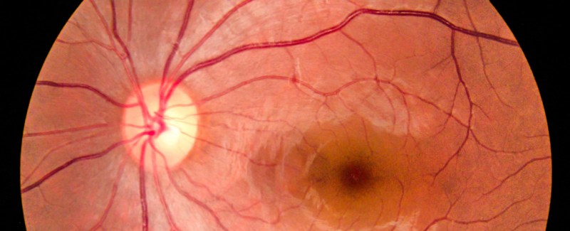 Yleisen terveydentilan vaikutus silmien terveyteen
